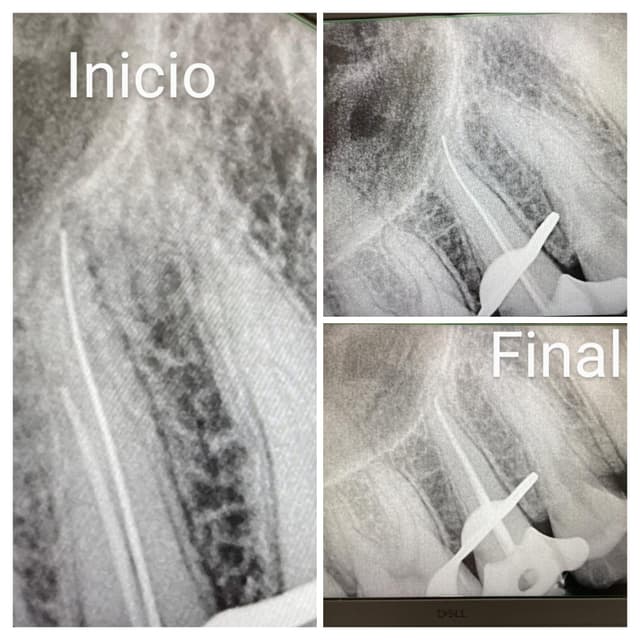 Endodoncias