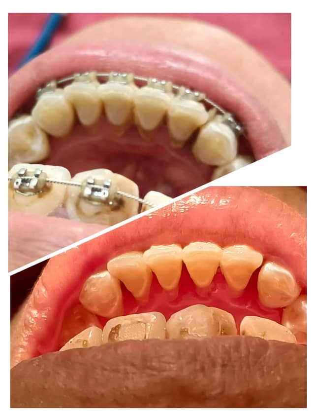 Limpieza dental (profilaxis)